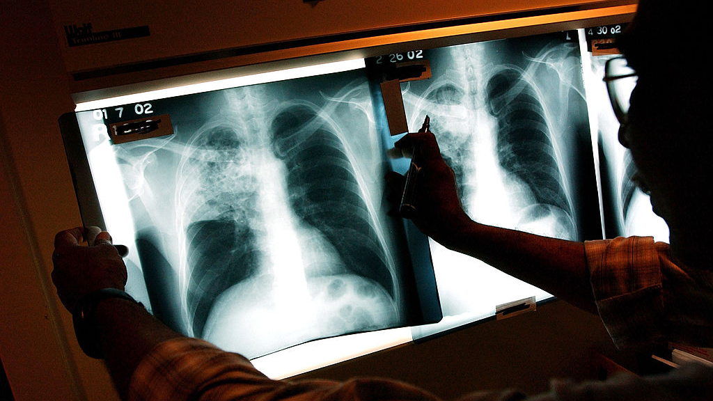 2 active tuberculosis cases traced to San Francisco strip club — KTVU FOX 2 Bay Area, Los Altos Health news